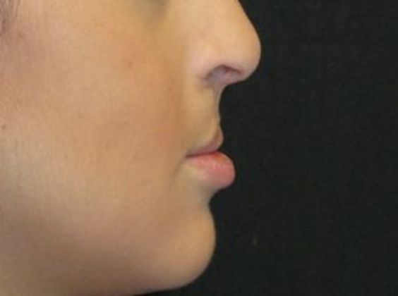 Lip Implants: Case 8 - before