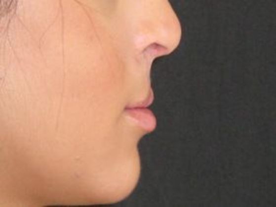 Lip Implants: Case 8 - after 1 month