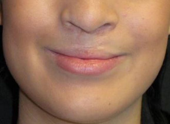 Lip Implants: Case 8 - before with a smile
