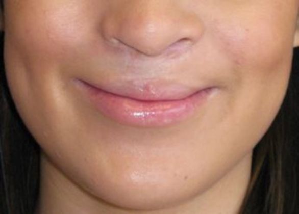 Lip Implants: Case 8 - after 1 month with a smile