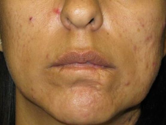 Lip Implants: Case 9 - before