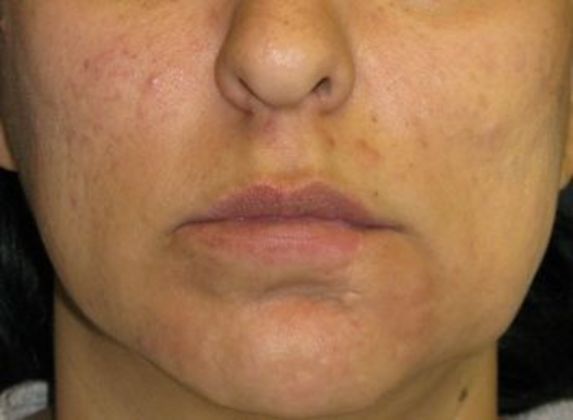 Lip Implants: Case 9 - after 2 months