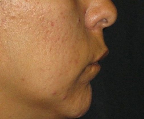 Lip Implants: Case 9 - before