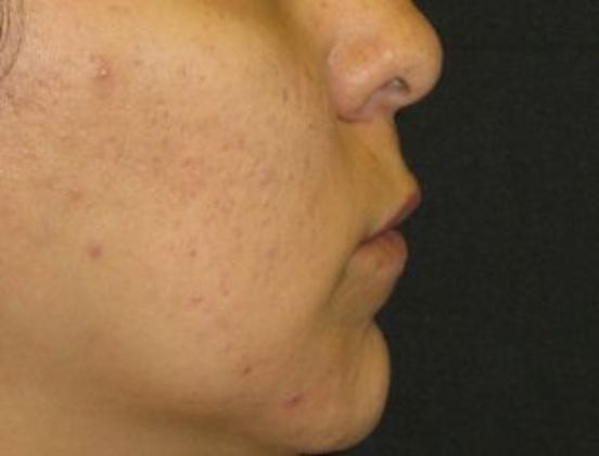 Lip Implants: Case 9 - after 2 months