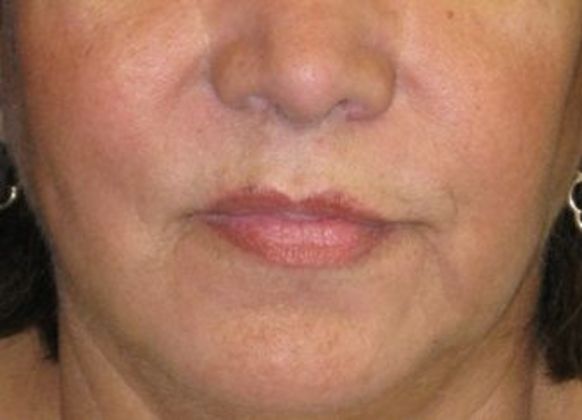 Lip Implants: Case 10 - before