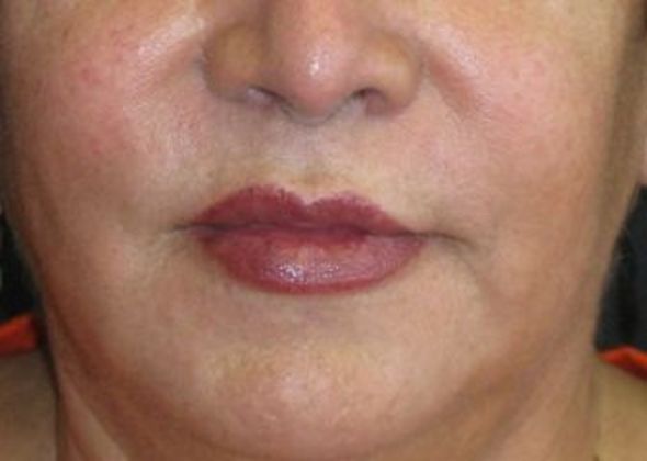 Lip Implants: Case 10 - after 3 months