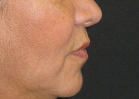 Lip Implants: Case 10 - before