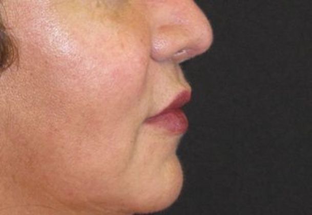 Lip Implants: Case 10 - after 3 months