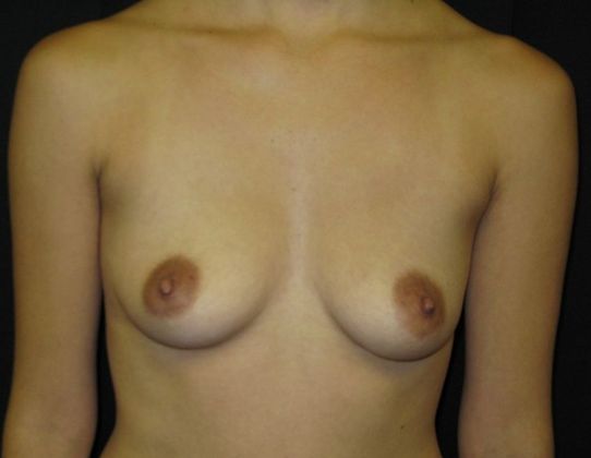 Breast Augmentation: Case 2 - before