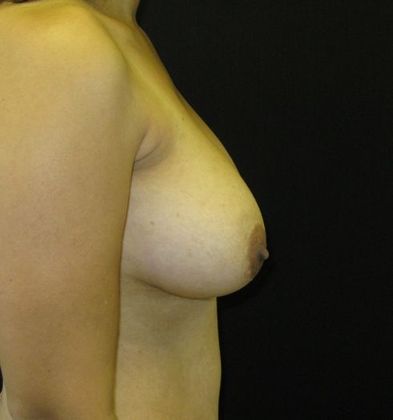 Breast Augmentation: Case 3 - after 2 years
