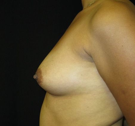 Breast Augmentation: Case 3 - before