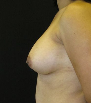 Breast Augmentation: Case 3 - after 2 years