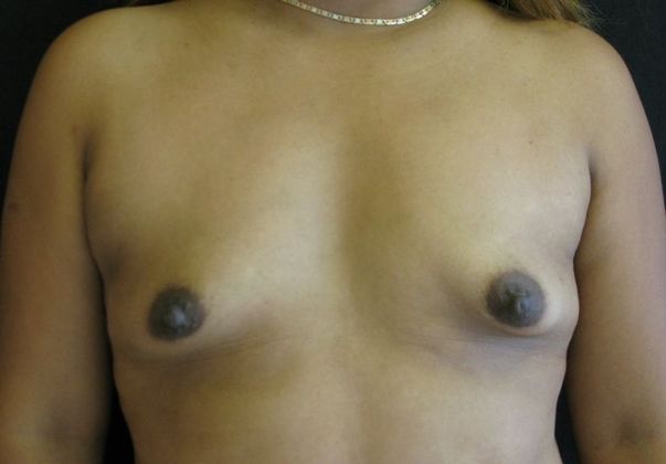 Breast Augmentation Case 4 - Before