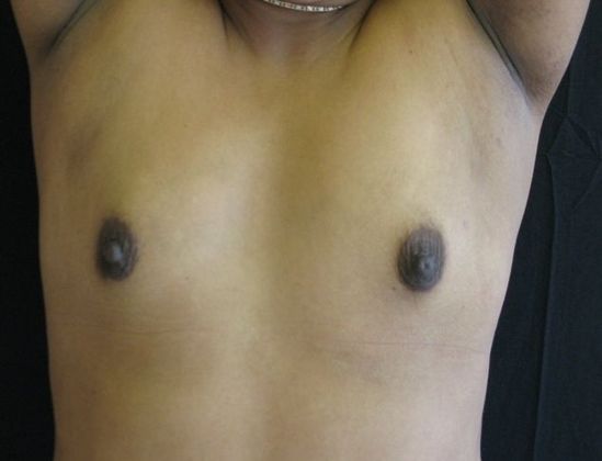 Breast Augmentation: Case 4 - before, arms up