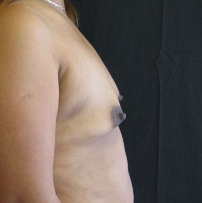 Breast Augmentation: Case 4 - before