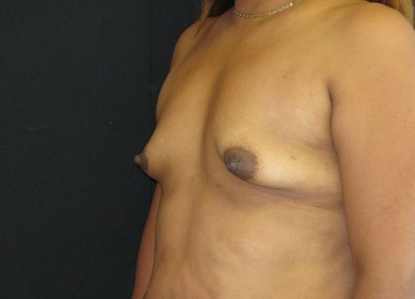 Breast Augmentation: Case 4 - before