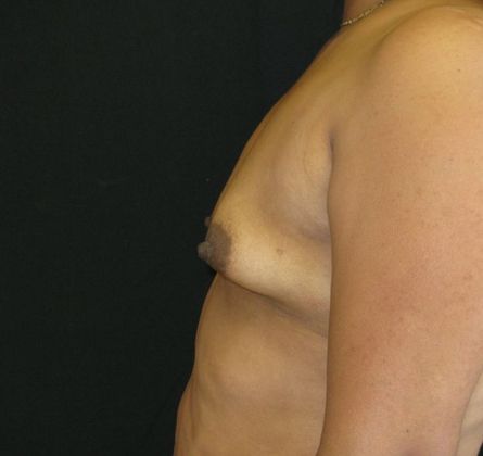 Breast Augmentation: Case 4 - before