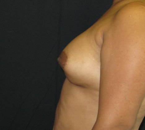 Breast Augmentation: Case 4 - after 2 months