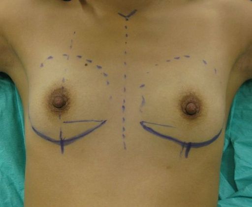 Breast Augmentation: Case 5 - before 