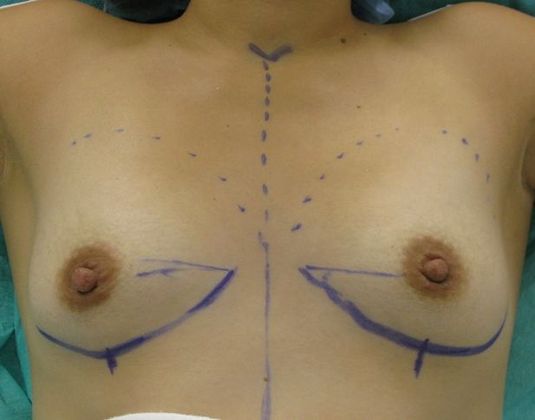 Breast Augmentation: Case 6 - before