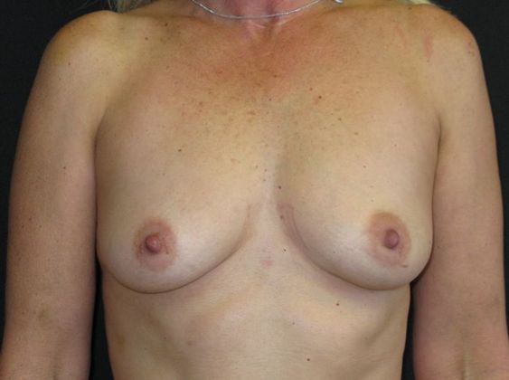 Breast Augmentation Case 7 - Before