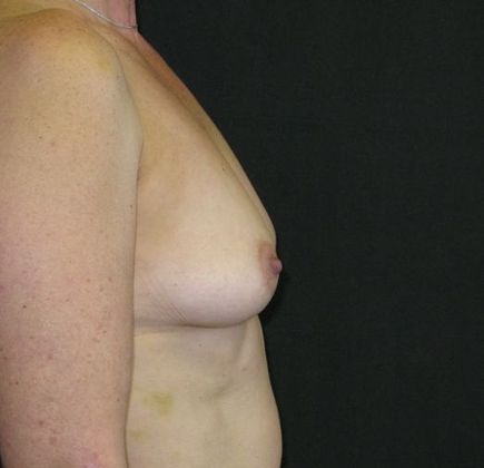 Breast Augmentation: Case 7 - before