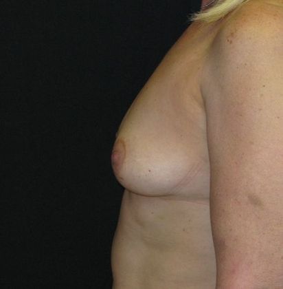 Breast Augmentation: Case 7 - before