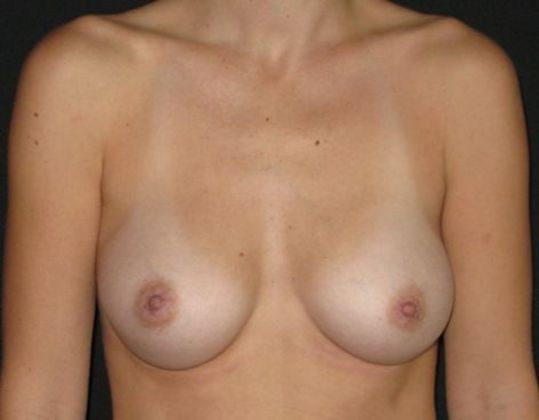 Breast Augmentation: Case 8 - after 9 months