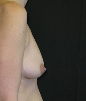 Breast Augmentation: Case 8 - before