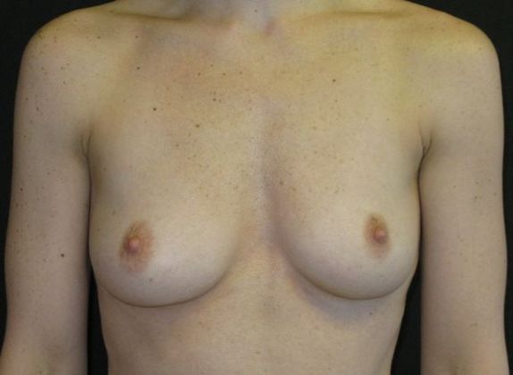 Breast Augmentation Case 9 - Before