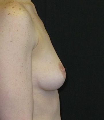Breast Augmentation: Case 9 - before