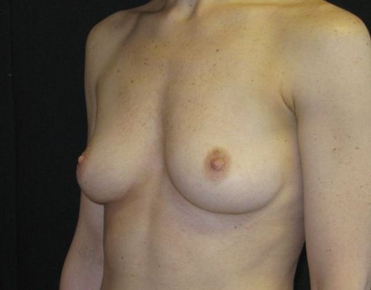 Breast Augmentation: Case 9 - before