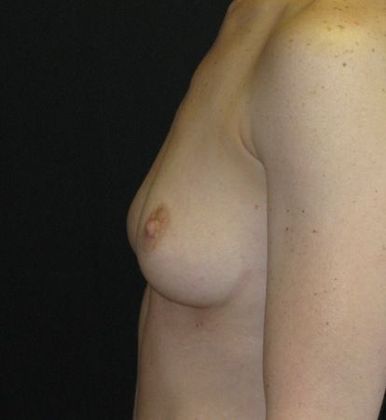 Breast Augmentation: Case 9 - before