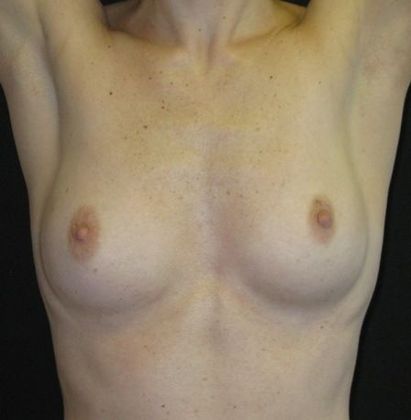 Breast Augmentation: Case 9 - before
