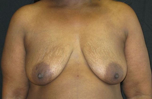 Breast Augmentation: Case 10 - before