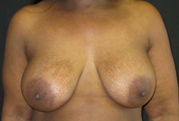 Breast Augmentation: Case 10 - after 5 months