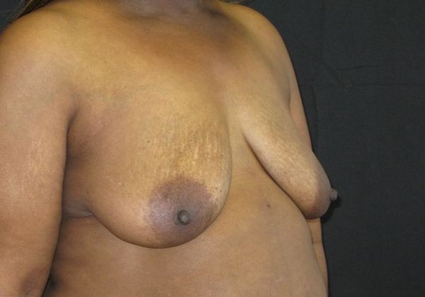Breast Augmentation: Case 10 - before