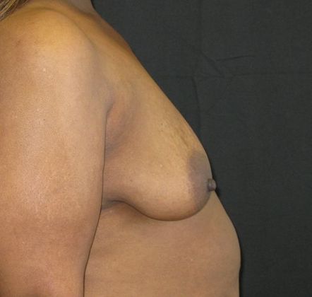 Breast Augmentation: Case 10 - before