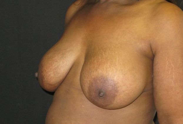 Breast Augmentation: Case 10 - after 5 months