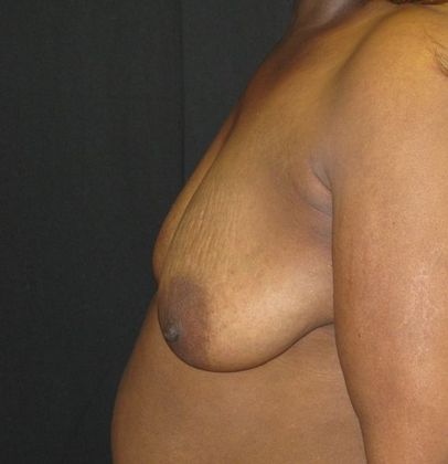 Breast Augmentation: Case 10 - before