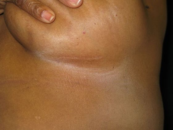 Breast Augmentation: Case 10 - scar under left breast at 5 months
