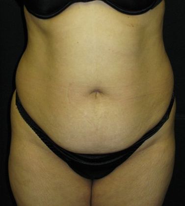 Abdominoplasty Case 1 - Before
