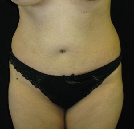 Abdominoplasty Case 1 - After