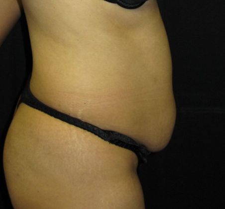 Abdominoplasty: Case 1 - before