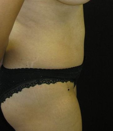Abdominoplasty: Case 1 - after 2 years