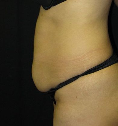 Abdominoplasty: Case 1 - before