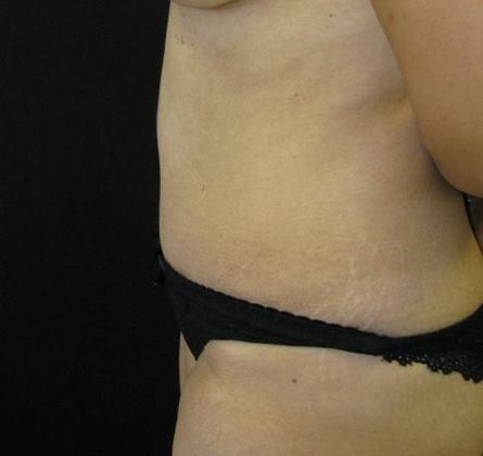 Abdominoplasty: Case 1 - after 2 years