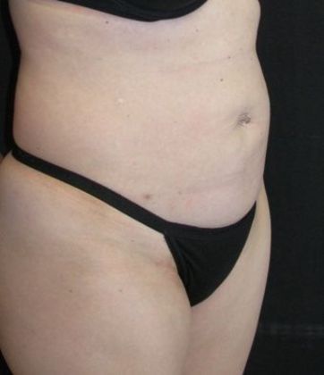 Abdominoplasty: Case 2 - before