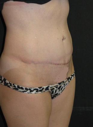 Abdominoplasty: Case 2 - after 9 months