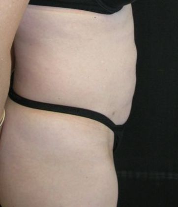 Abdominoplasty: Case 2 - before